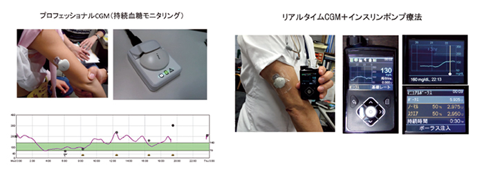 持続グルコースモニタリング（CGM）
